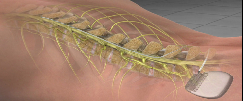Spinal cord stimulation device illustration